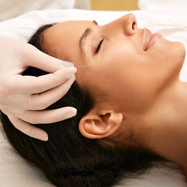 What is Cosmetic Acupuncture? woman having cosmetic acupuncture treatment to remove wrinkles