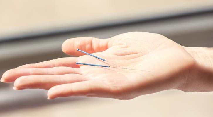 Micro Acupuncture NYC and Acunova by Marc Bystock L.Ac.