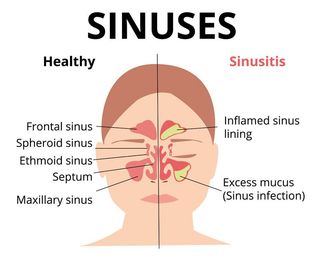 NYC Sinusitis Treatments by Marc Bystock NYC Acupuncturist in Midtown Manhattan NY 10016