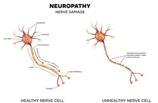 NYC Neuropathy Acupuncture Treatment by Marc Bystock in Midtown Manhattan NY 10016