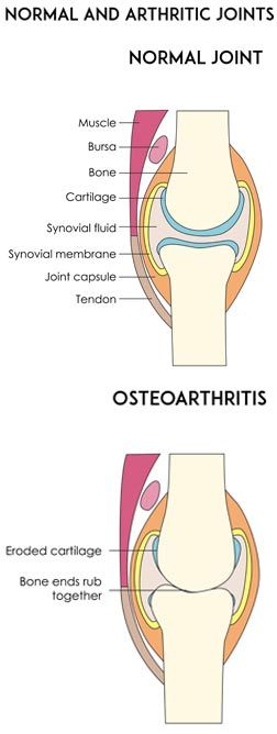 Osteoarthritis Pain Relief by Marc Bystock NYC Acupuncturist in Midtown Manhattan NY