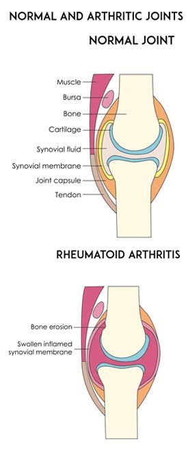 Rheumatoid Arthritis Pain Relief by Marc Bystock NYC Acupuncturist in Midtown Manhattan NY