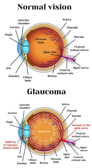 What Causes Glaucoma? Treatment for Glaucoma by Marc Bystock NYC Acupuncturist in Midtown Manhattan