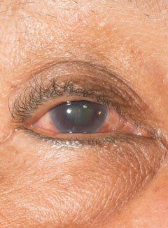 Treatments for Eye Degeneration NYC Acupuncturist in Midtown Manhattan NY 10016