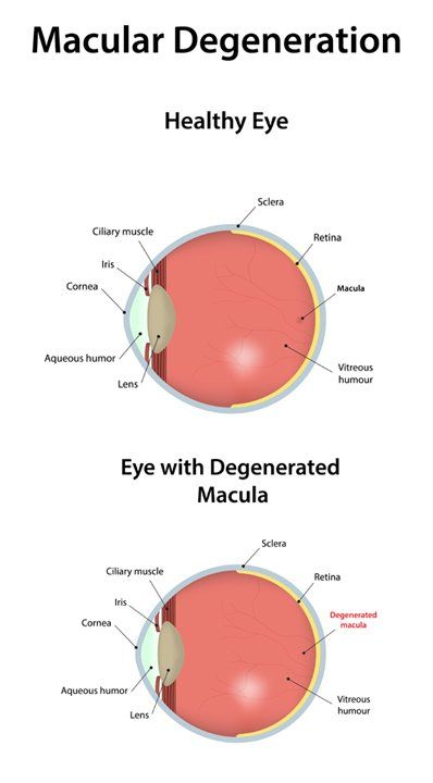 Treatments for Macular Degeneration by Marc Bystock NYC Acupuncturist in Midtown Manhattan