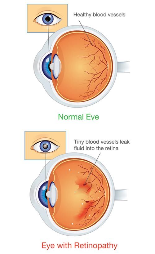 Acupuncture for Diabetic Retinopathy by Marc Bystock NYC Acupuncturist in Midtown Manhattan NY 10016