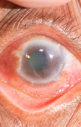eye degeneration disorder treatments