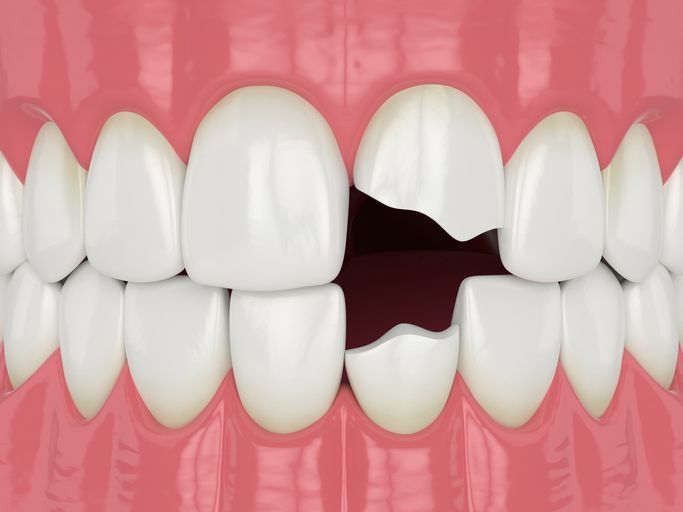 A digital illustration showing upper and lower human teeth with chipped enamel and a large gap between the front teeth.