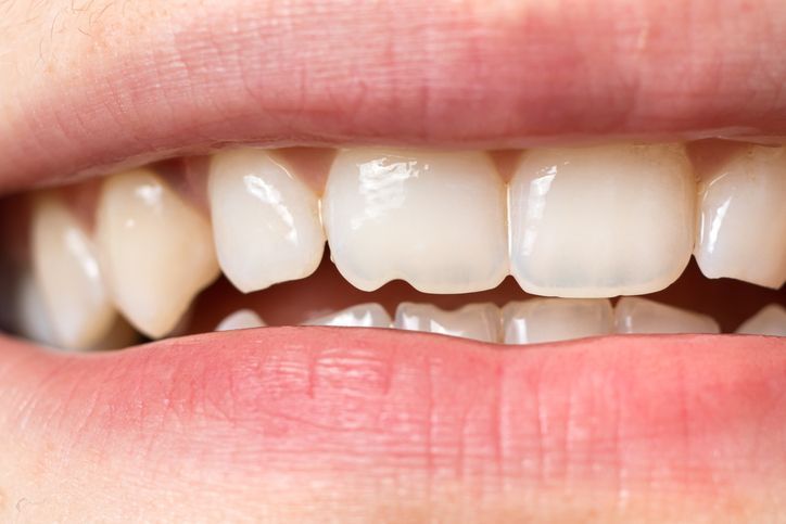Close-up of a person's upper front teeth, showing a small chip on the bottom edge of a central incisor.