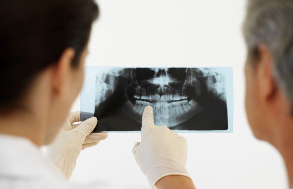 Looking at teeth replacement on an x-ray in Anchorage, AK