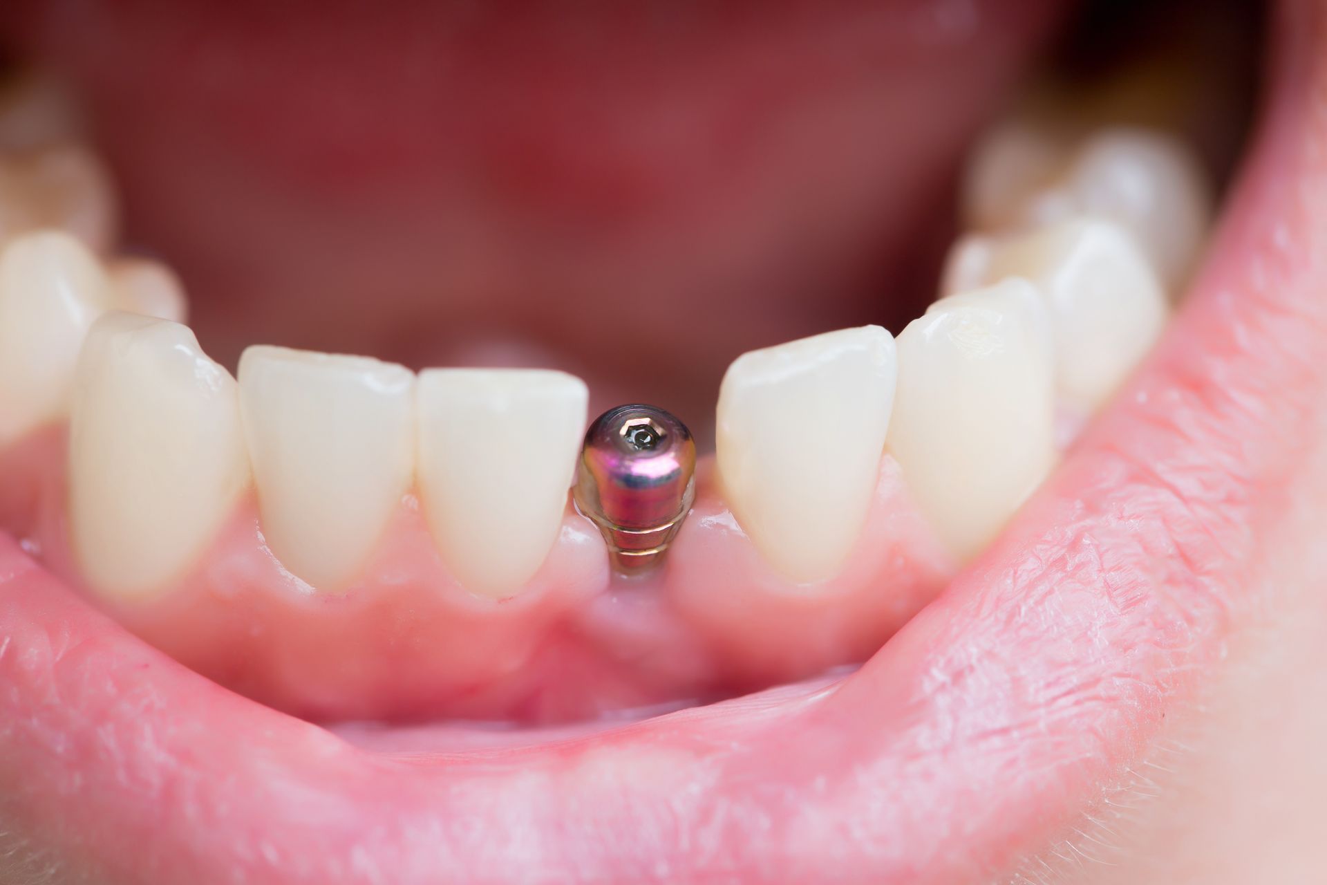 Dental implants abutment placed in the lower front jaw between natural teeth