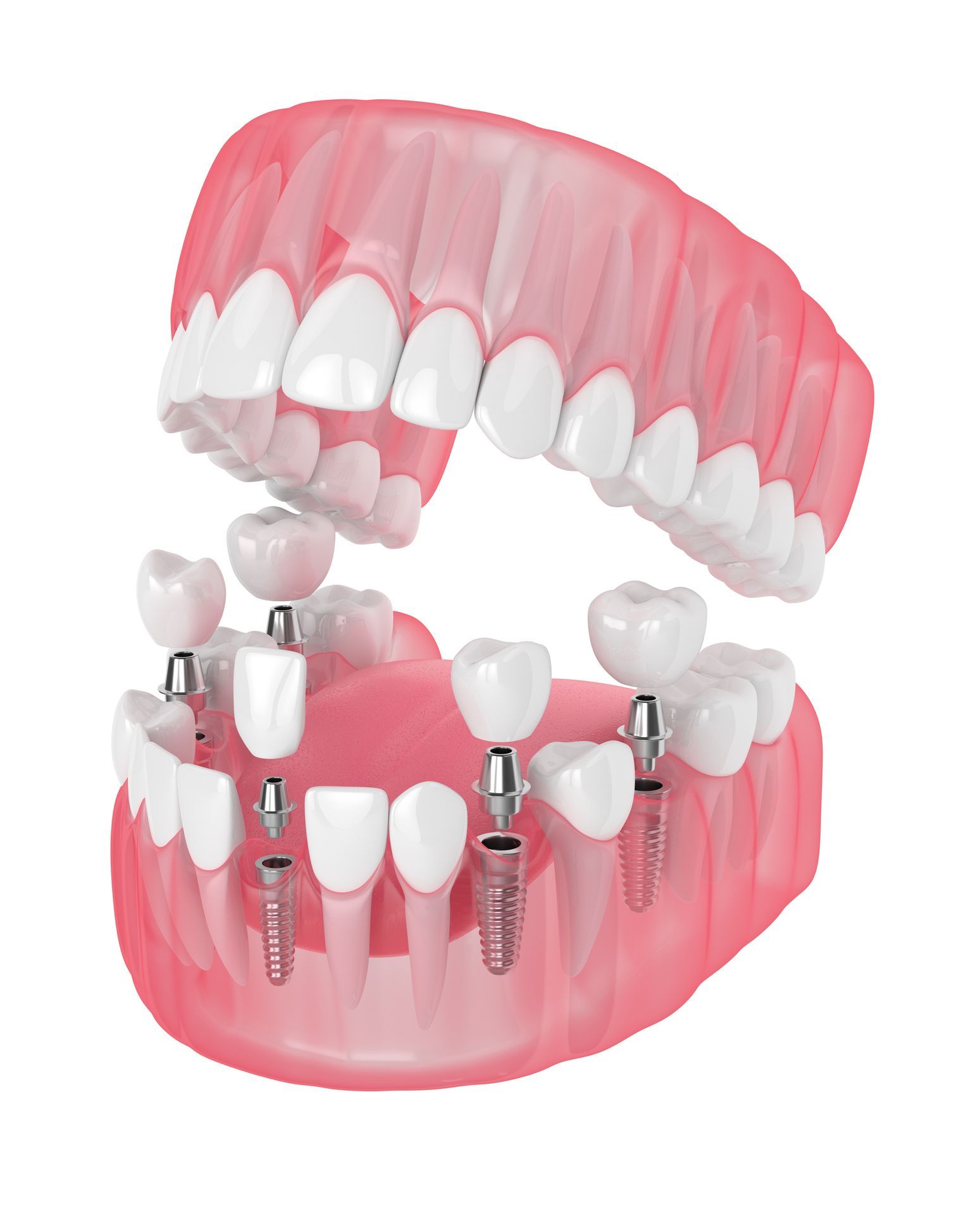 3D rendering of lower jaw with dental fixtures installed in gum.
