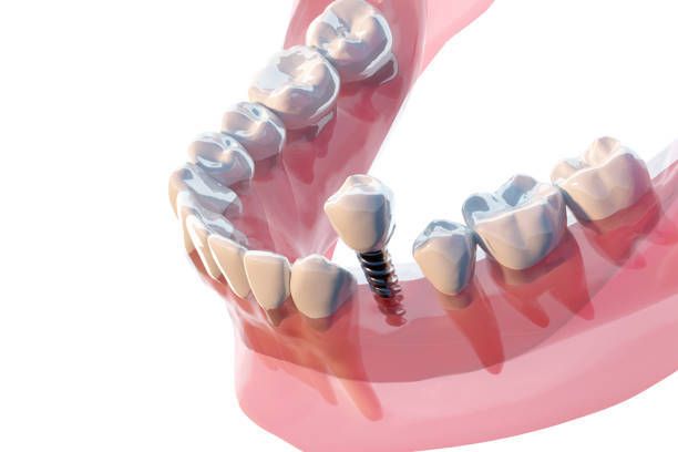 3D rendering of lower jaw with dental fixtures installed in gum.