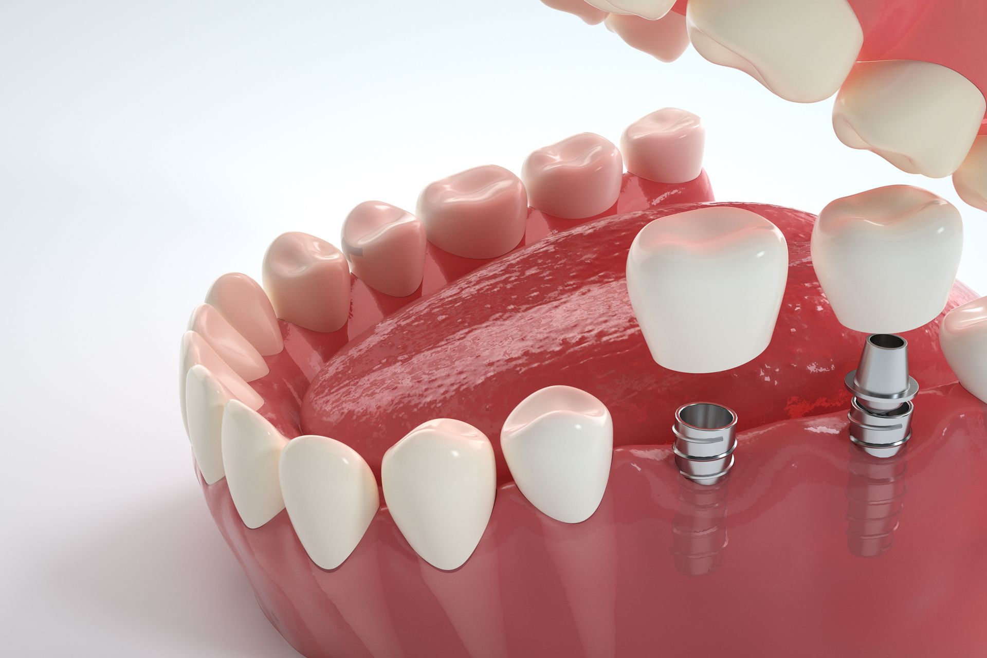 3D rendering of lower jaw with dental fixtures installed in gum.