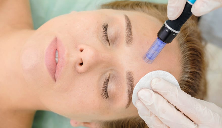 A woman is getting a microneedle treatment on her face.