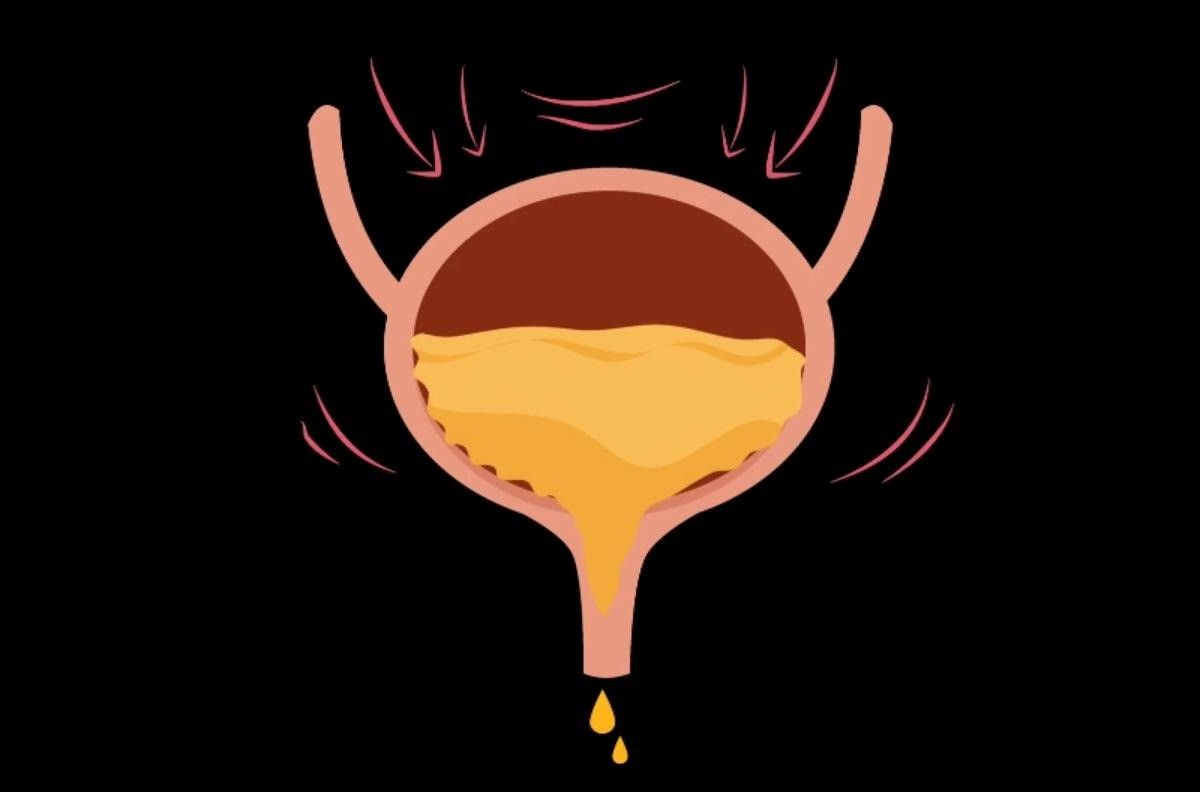 Cirurgia de sling para incontinência urinária: entenda