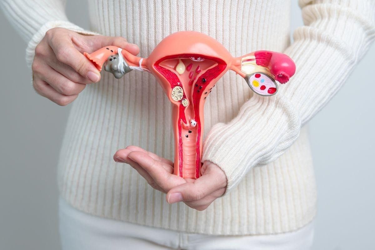 endometriose-tratamento-dra-camila-poccetti-ginecologista-sao-paulo