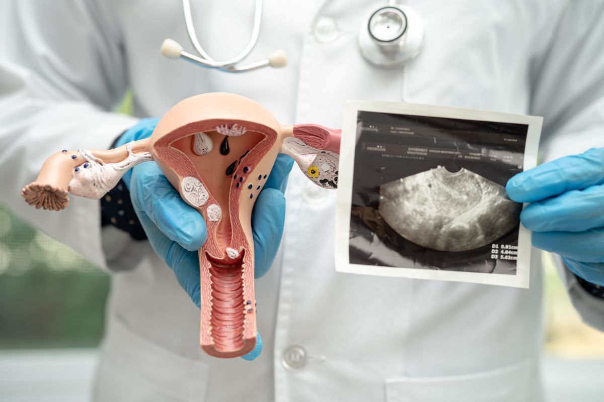 Tratamentos para mioma uterino: conheça as opções