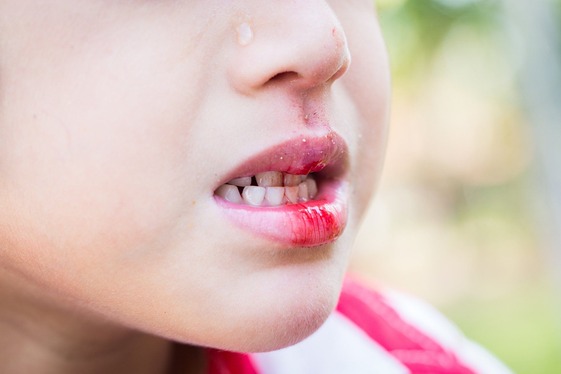 Zahnunfälle Erste Hilfe am Kind online