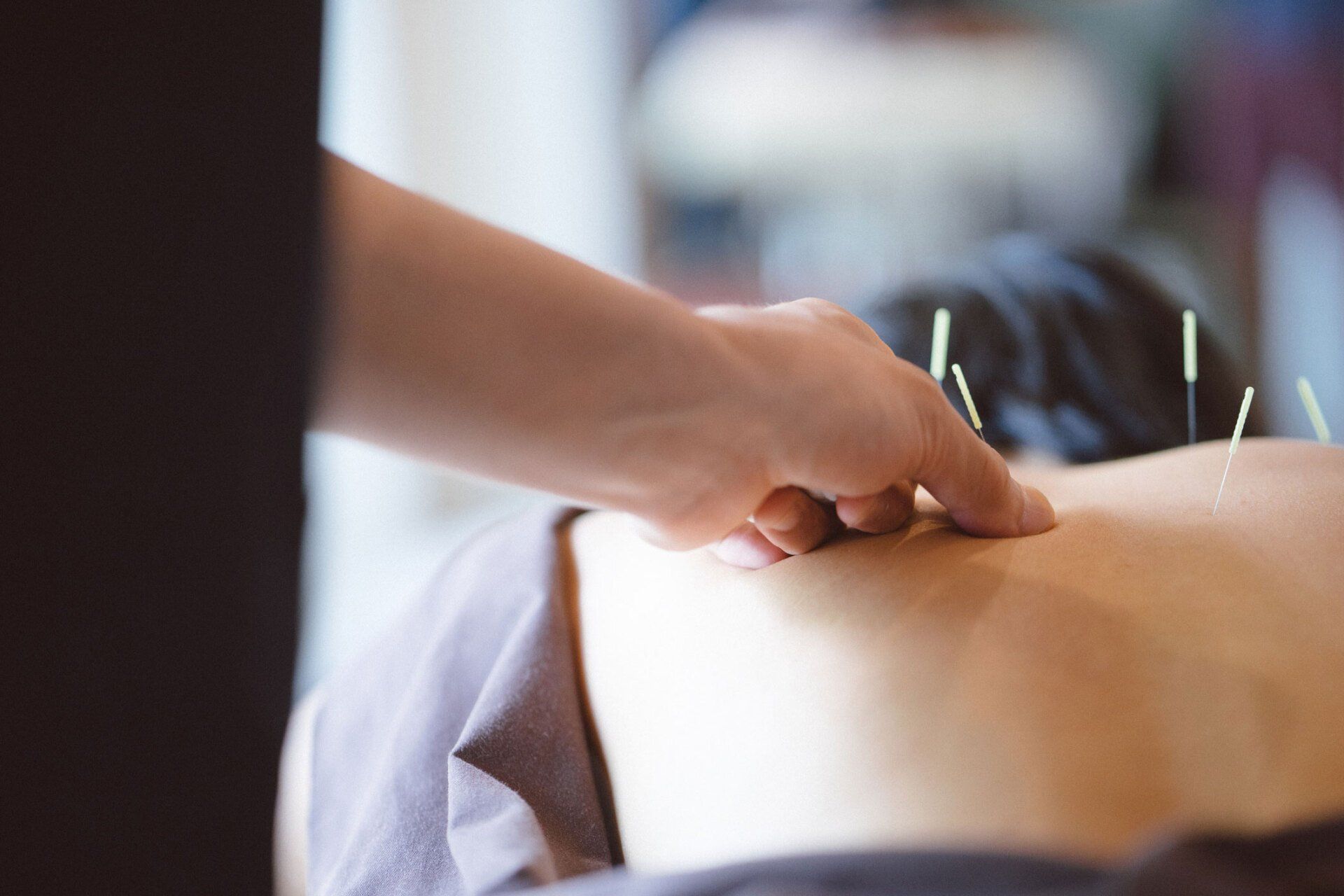 Patient Receiving Acupuncture Treatment — Plympton, SA — Aaron Slape Acupuncturist