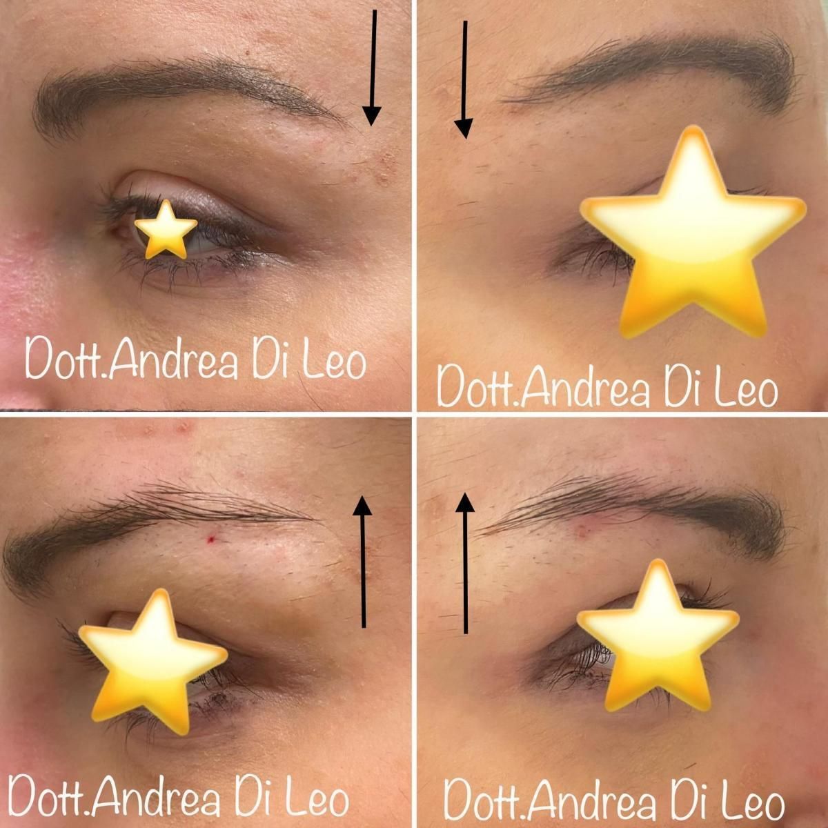 Quattro foto delle sopracciglia di una donna del dott andrea di leo