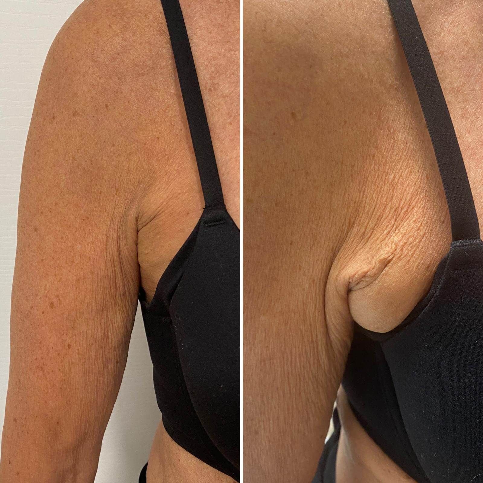 Filler rigenerativo dei tessuti prima e dopo l'intervento