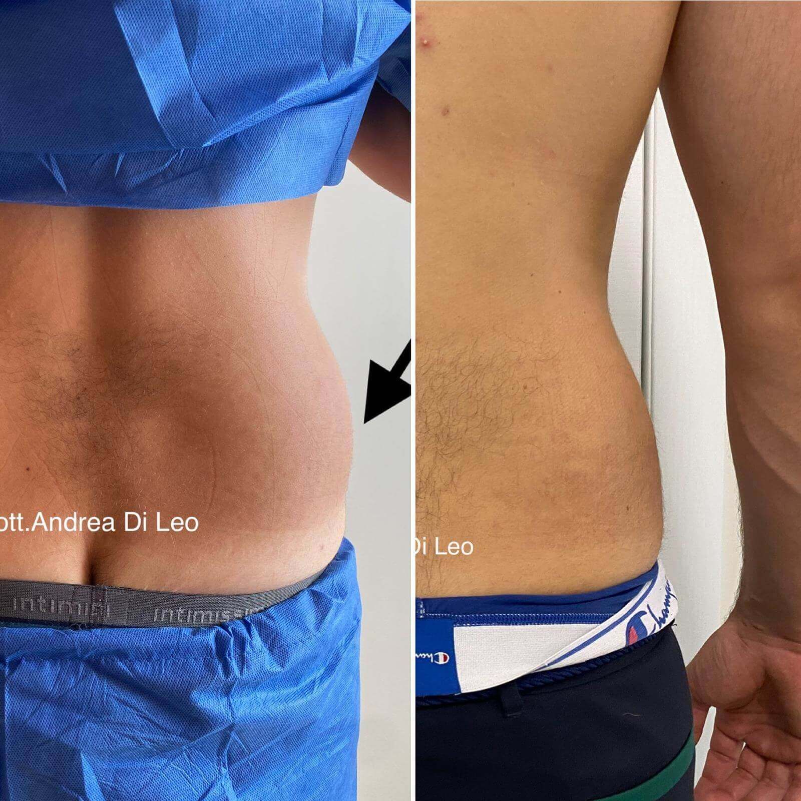 Una foto prima e dopo del torso di un uomo di andrea di leo