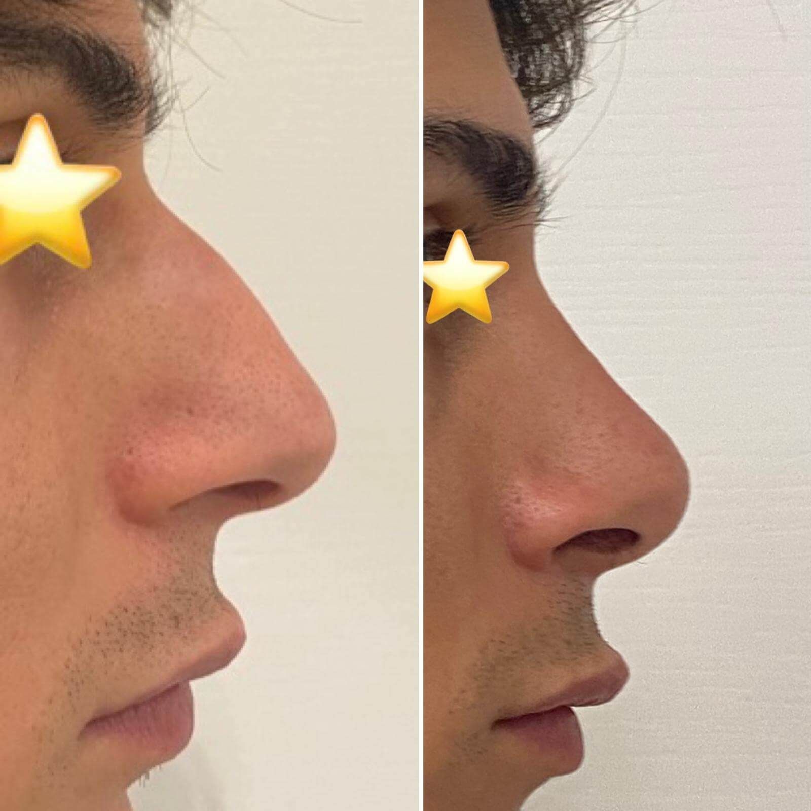 Una foto del prima e del dopo del naso di un uomo.