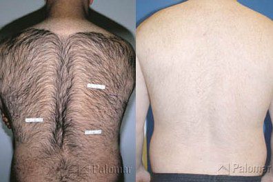 Skin Laser — Men HairyBack Before and After the Skin Laser Removal  in Wellington, FL