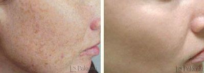 Intense Pulse Light — Women Face with Pipmple Before and After IPL in Wellington, FL
