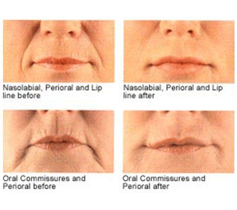 Dermatology Center — Old Women Face Before and After Perlane in Wellington, FL