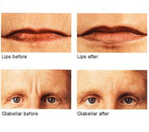 Dermatologist — Guy Face and Lips After Surgery in Wellington, FL