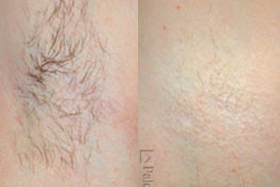 Removing Hair — Skin Hair Before and After Using Laser Removal in Wellington, FL