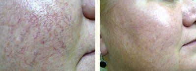 Cosmetics — Women Face Before and After Photorejuvenation in Wellington, FL
