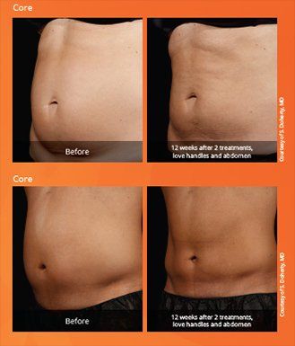 Sculpsure — Women and Men Body Before and After the Treatment in Wellington, FL