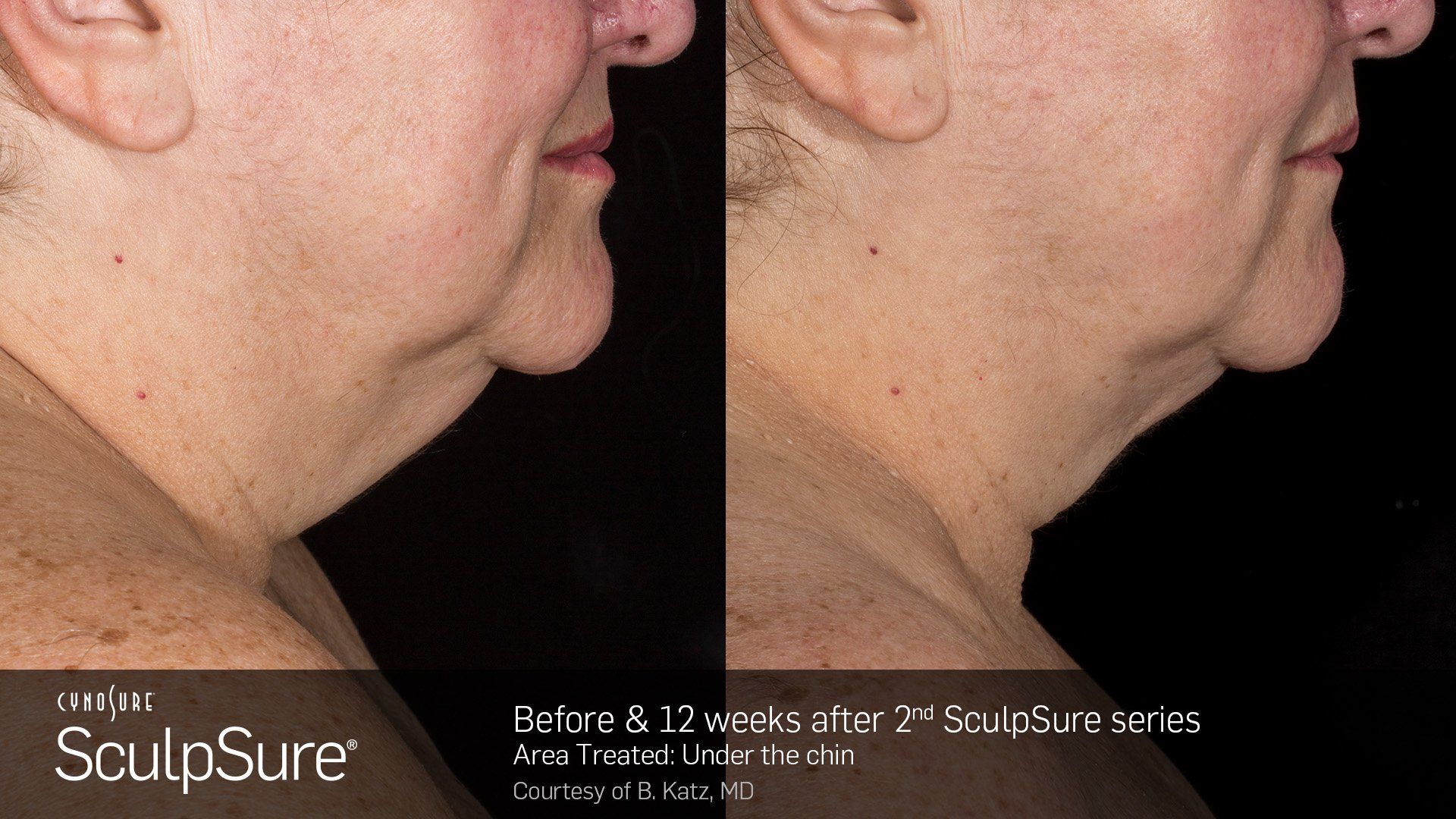 Dermatology Center Of Wellington  Meso Therapy — Woman Chin Before and After in Wellington, FL
