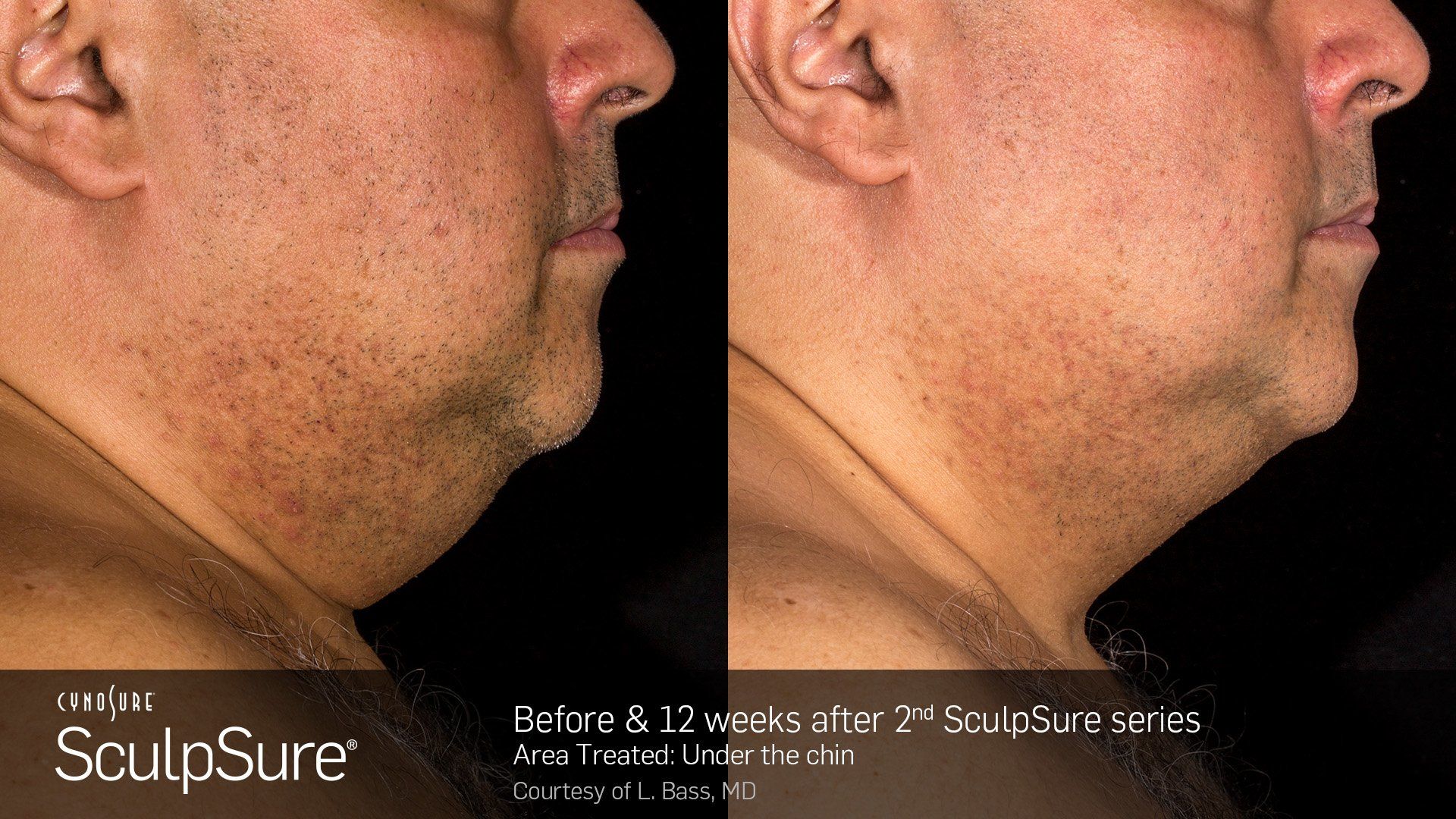 Dermatology Center Of Wellington  Hair Removal —  Man Chin Before and After in Wellington, FL