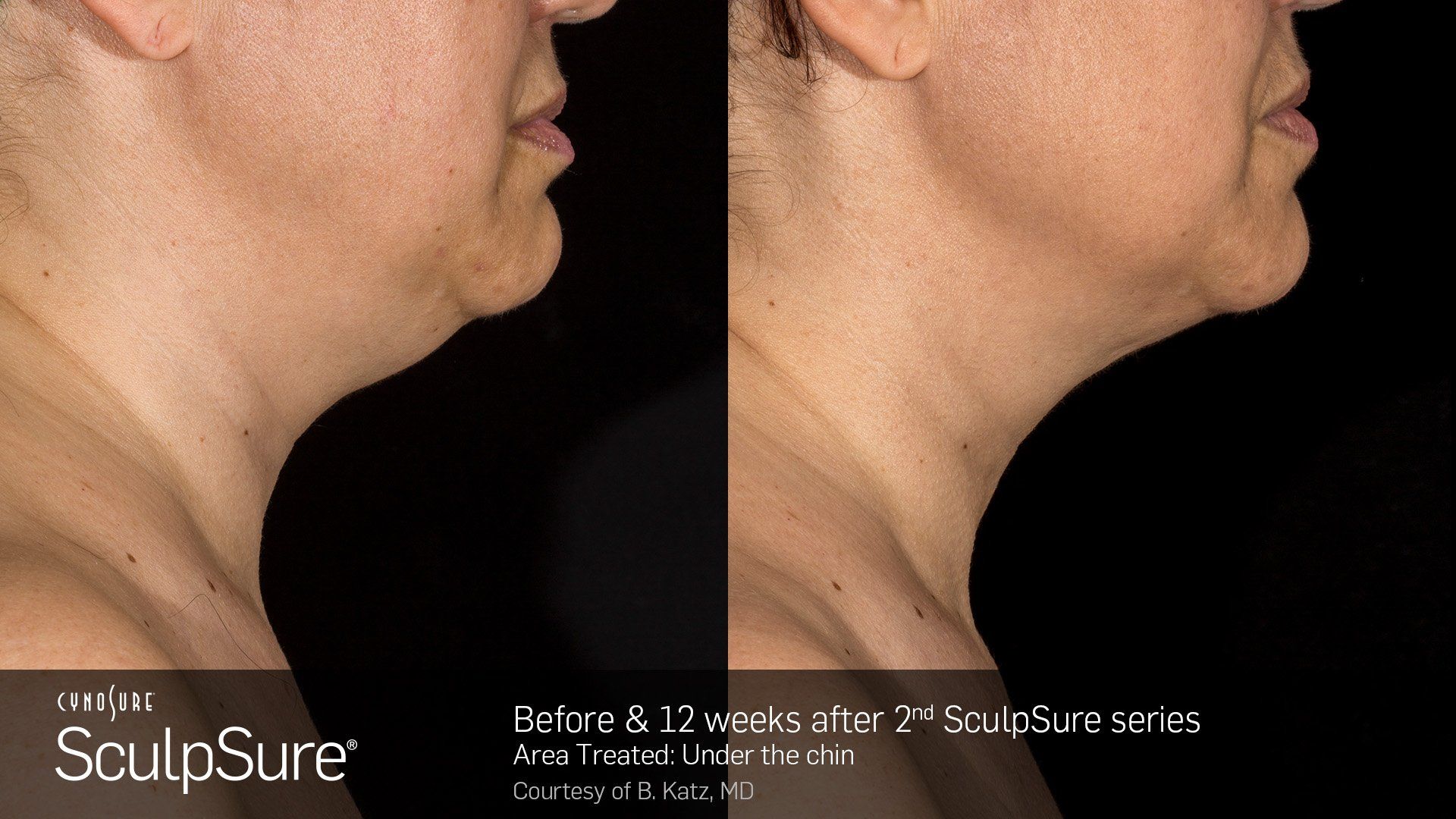 Dermatology Center Of Wellington  Facials — Women Showing Neck Side VIew in Wellington, FL