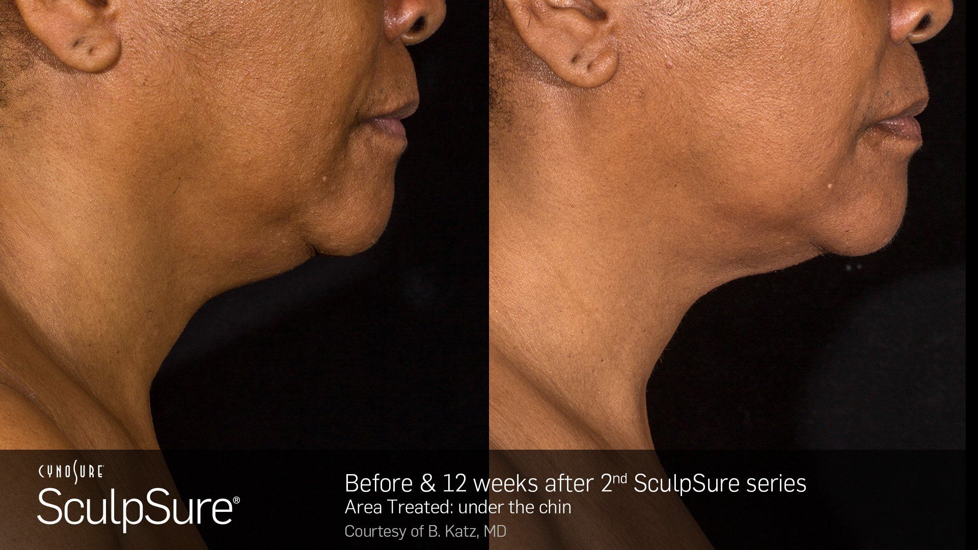 Dermatology Center Of Wellington  Sculpture — Woman with two Ear Piercing in Wellington, FL