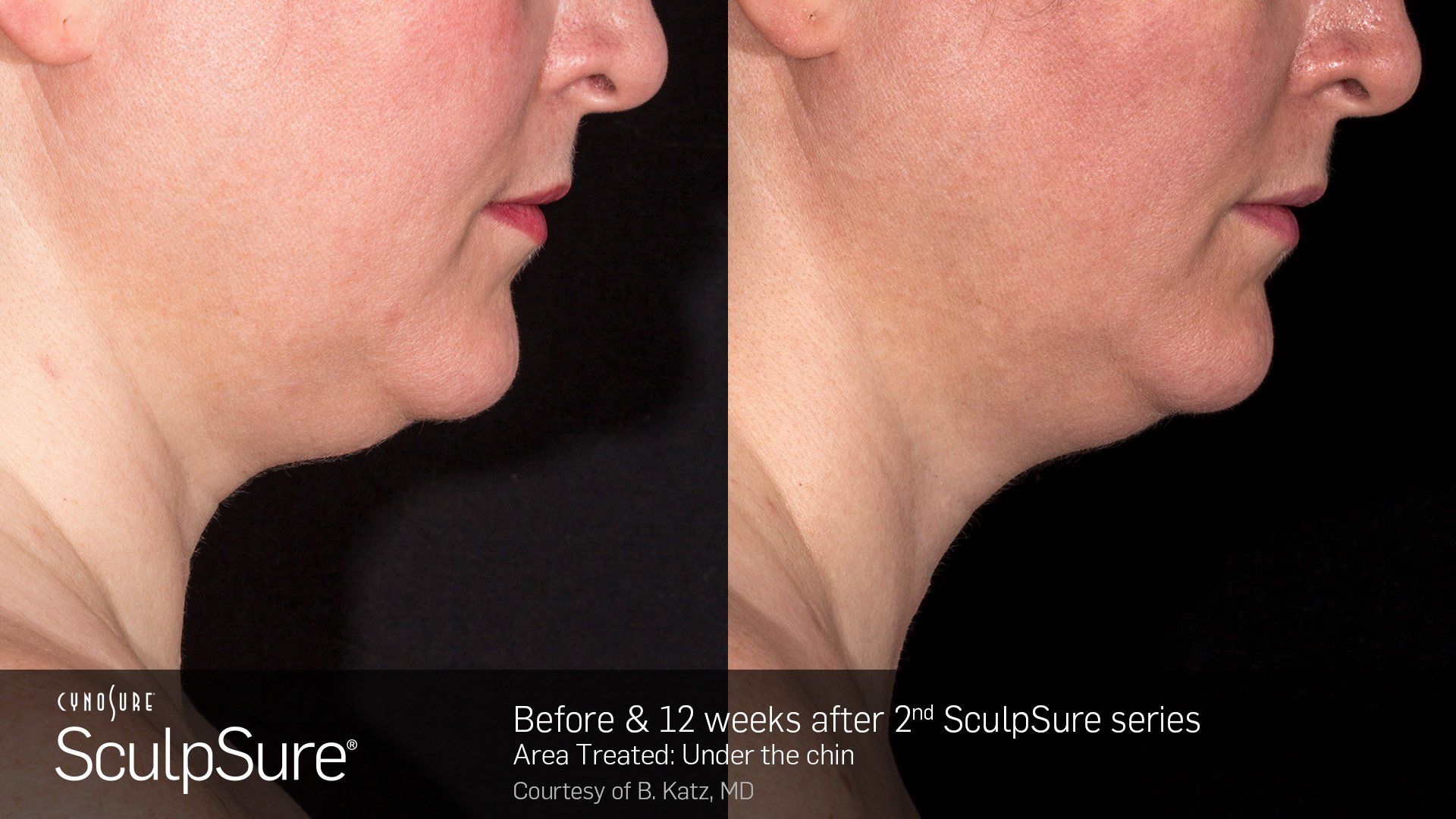 Dermatology Center Of Wellington  Plastic Surgery — Man Side view Before and After in Wellington, FL