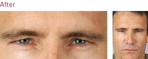 Botox — Forehead of Guy After Botox in Wellington, FL