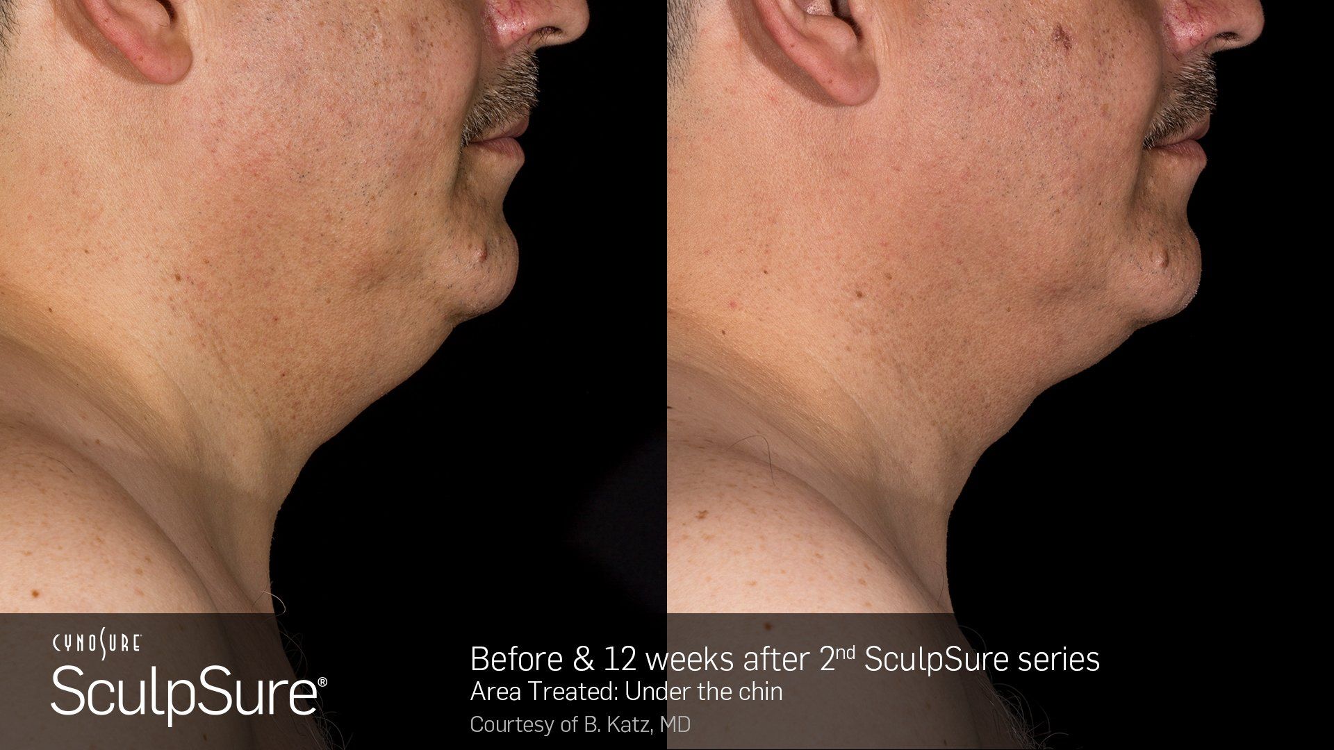 Dermatology Center Of Wellington  Plastic Surgeon — Man Side view Before and After in Wellington, FL
