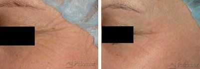 Resurfacing Laser  — Women Face before and After Resurfacing Laser in Wellington, FL