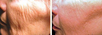 Fractional Non ablative Treatment — Old Women Cheeks Before and After the Treatment in Wellington, FL