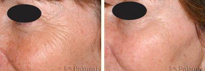 Laser Treatment — Old Women Face Before and After the Treatment in Wellington, FL