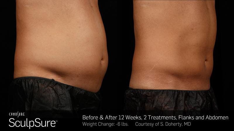 Sculpsure Treatment — Men Body Transformation After Consecutive Treatments in Wellington, FL