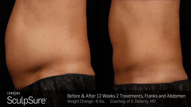 Cosmetic Treatment — Men Body Before and After in Wellington, FL