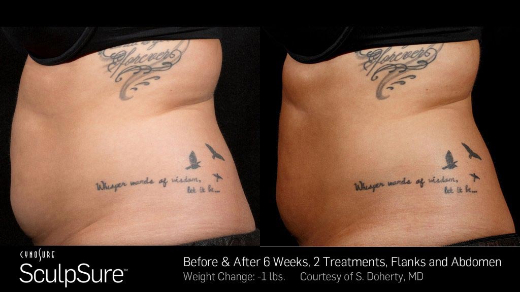 Cosmetic Surgery — Women Body with Tattoo in Wellington, FL