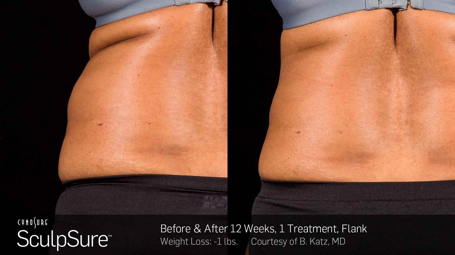 Cosmetic Surgery Florida — Women Back Before and After 12 Weeks in Wellington, FL