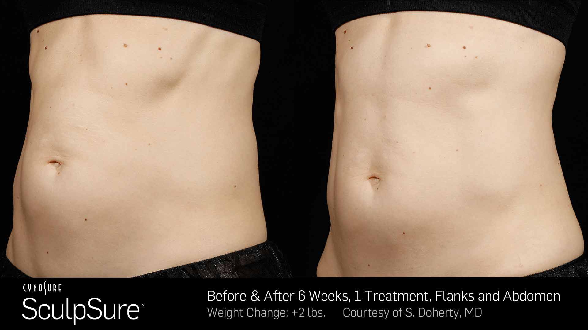Dermabrasion — Guy Body Before and After  in Wellington, FL